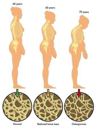 Figura 3. Representación de la pérdida de la masa ósea en el proceso de envejecimiento. Tomada de https://laanatomiadeisabel1.wordpress.com/2016/11/01/evolucion-del-sistema-musculo-esqueletico-en-las-etapas-de-adultez-y-ancianidad/