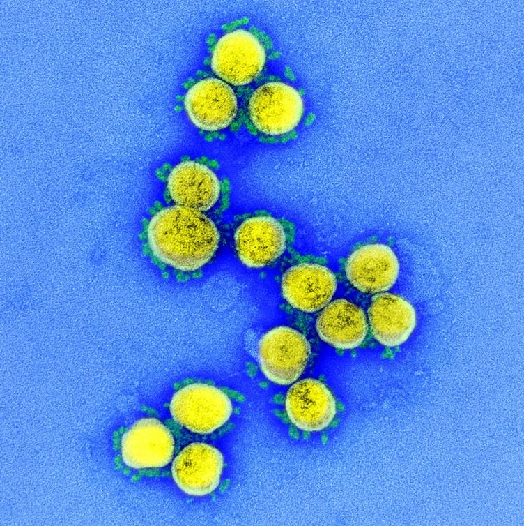Figura 4. Fotos de microscopio de barrido del SARS-CoV2. Microfotografía de transmisión de partículas del virus, aislada de un paciente. Tomada de: https://theconversation.com/el-virus-de-la-covid-19-ni-se-creo-ni-se-escapo-de-un-laboratorio-136773