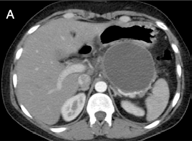 Figura 3. (a) Imagen que presenta la tomografía computarizada de una mujer de 24 años con un pseudoquiste pancreático de 10 × 10 × 9 cm. (b) Imagen obtenida al aplicar el detector de bordes fraccionario con un orden de 0.6.  