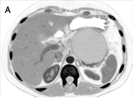 Figura 3. (a) Imagen que presenta la tomografía computarizada de una mujer de 24 años con un pseudoquiste pancreático de 10 × 10 × 9 cm. (b) Imagen obtenida al aplicar el detector de bordes fraccionario con un orden de 0.6.  